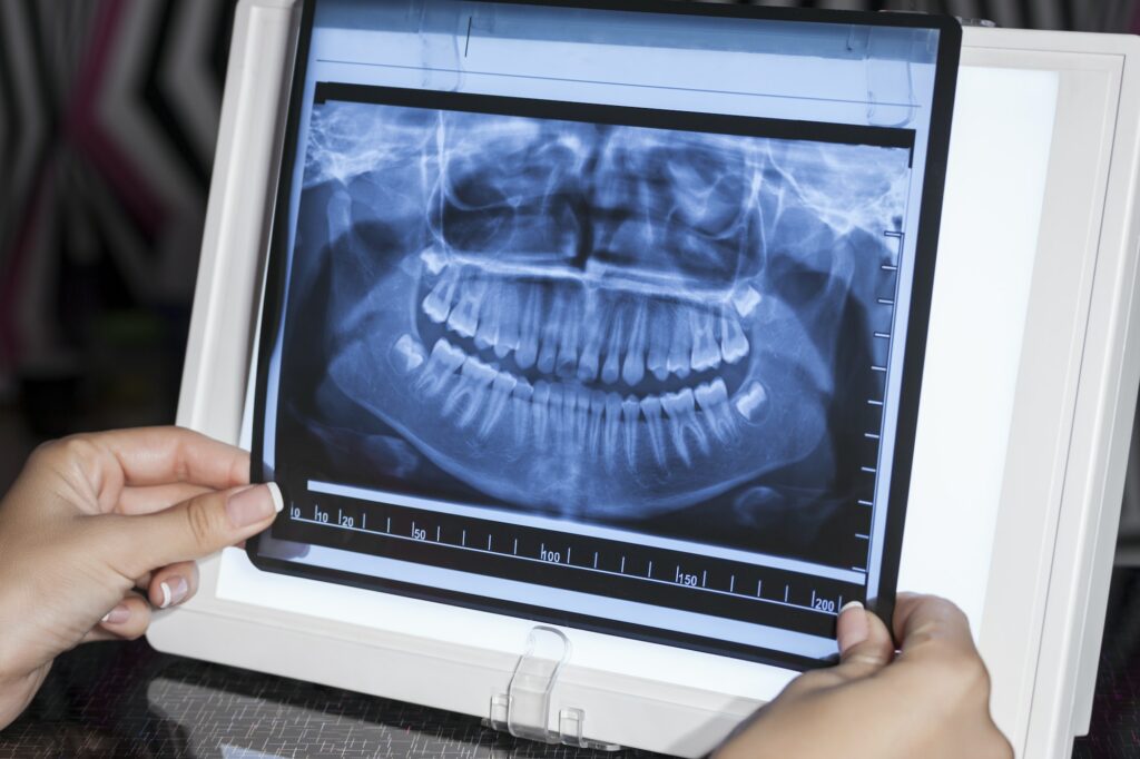 Panoramic Dental X-Ray